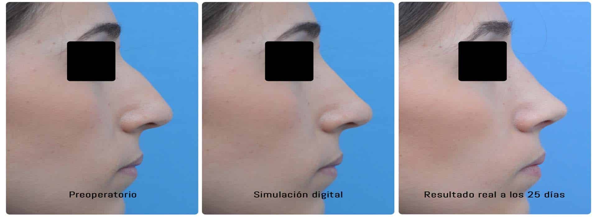 Antes y después de la rinoplastia en una mujer — Dr. Javier Galindo