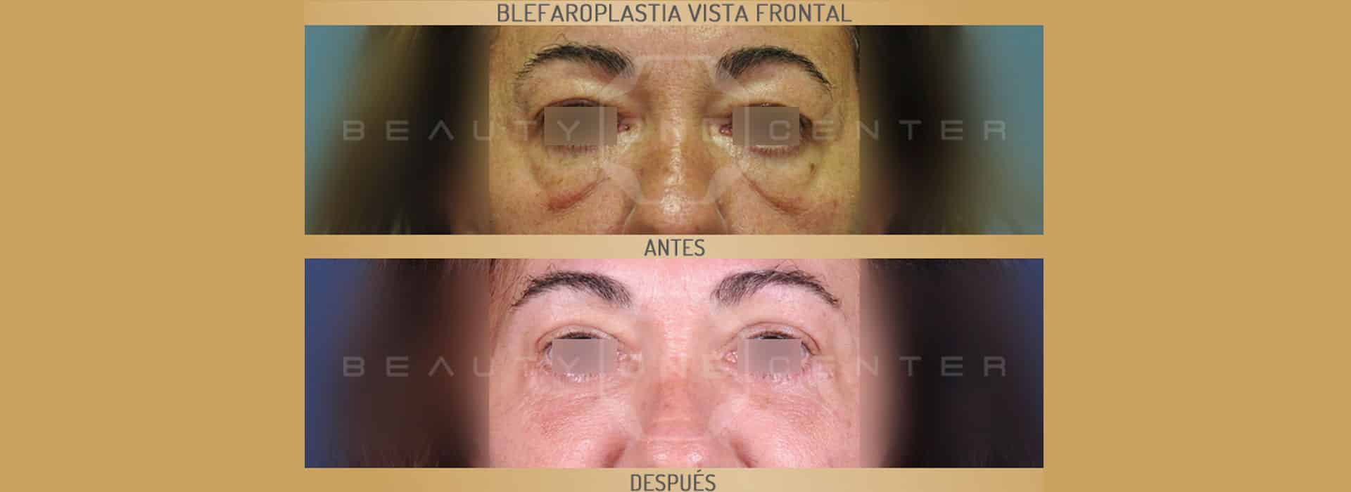 Blefaroplastia: Antes y después de una operación real — Dr. Javier Galindo