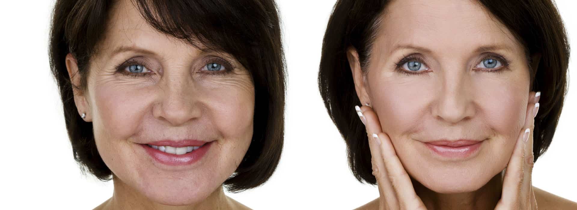 Cirugía antiaging o lifting cervicofacial ¿en qué consiste? — Dr. Javier Galindo