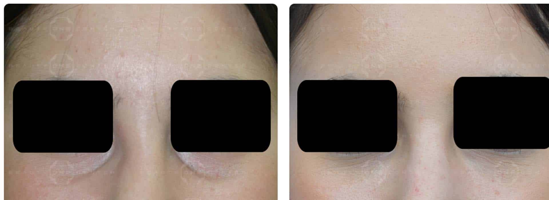 Operación de bolsas en los ojos: Tratamiento, resultado y precio — Dr. Javier Galindo