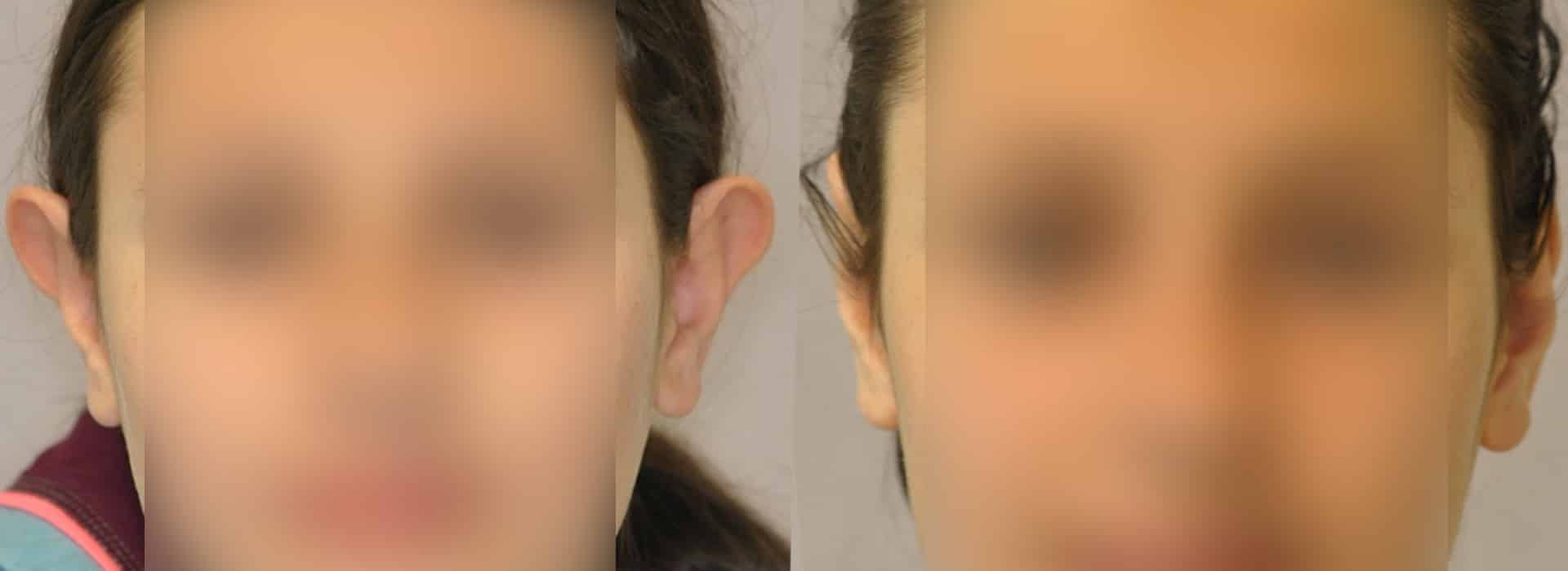 Orejas despegadas en los niños: ¿cómo afectan a mi hijo? — Dr. Javier Galindo