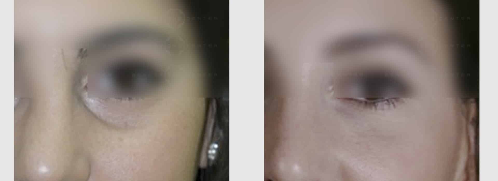 Despídete de las ojeras en Beauty ONE Center — Dr. Javier Galindo
