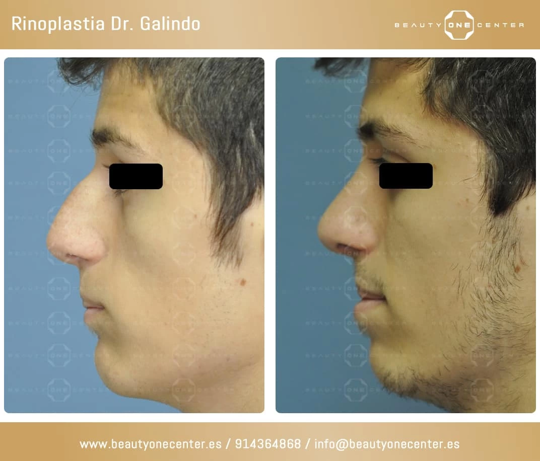 No son niños ni adultos: Rinoplastia en adolescentes — Dr. Javier Galindo