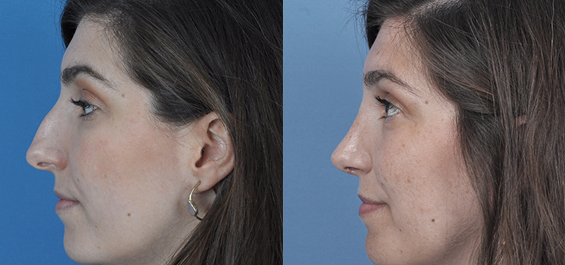Rinoplastia Ultrasónica — Dr. Javier Galindo