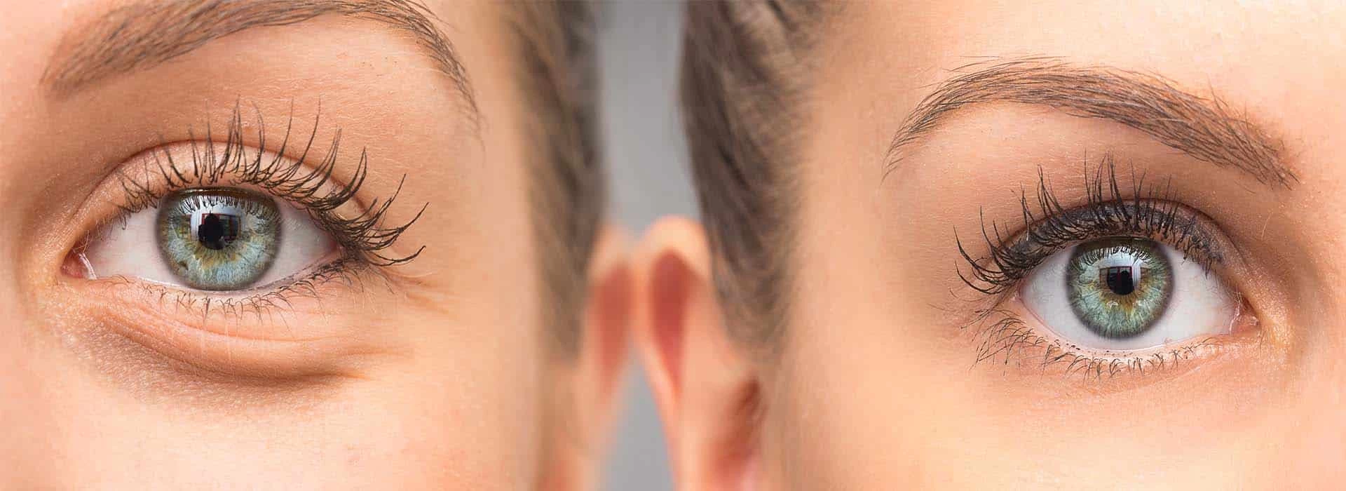 Blefaroplastia Inferior — Dr. Javier Galindo Madrid