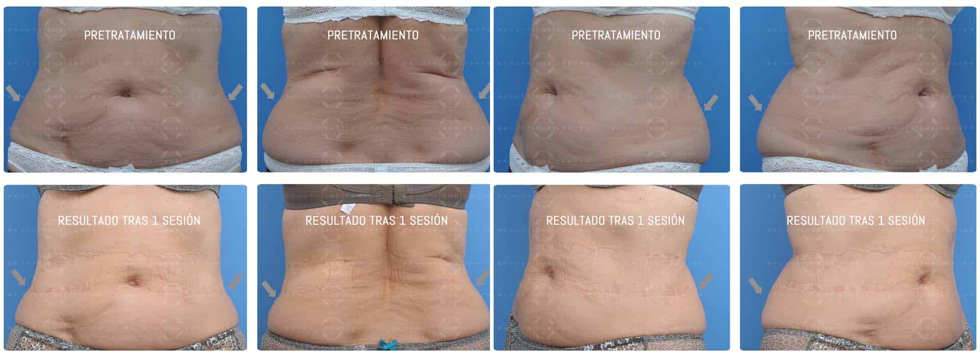 ¿Qué es coolsculpting®? La reducción de grasa corporal sin cirugía — Dr. Javier Galindo