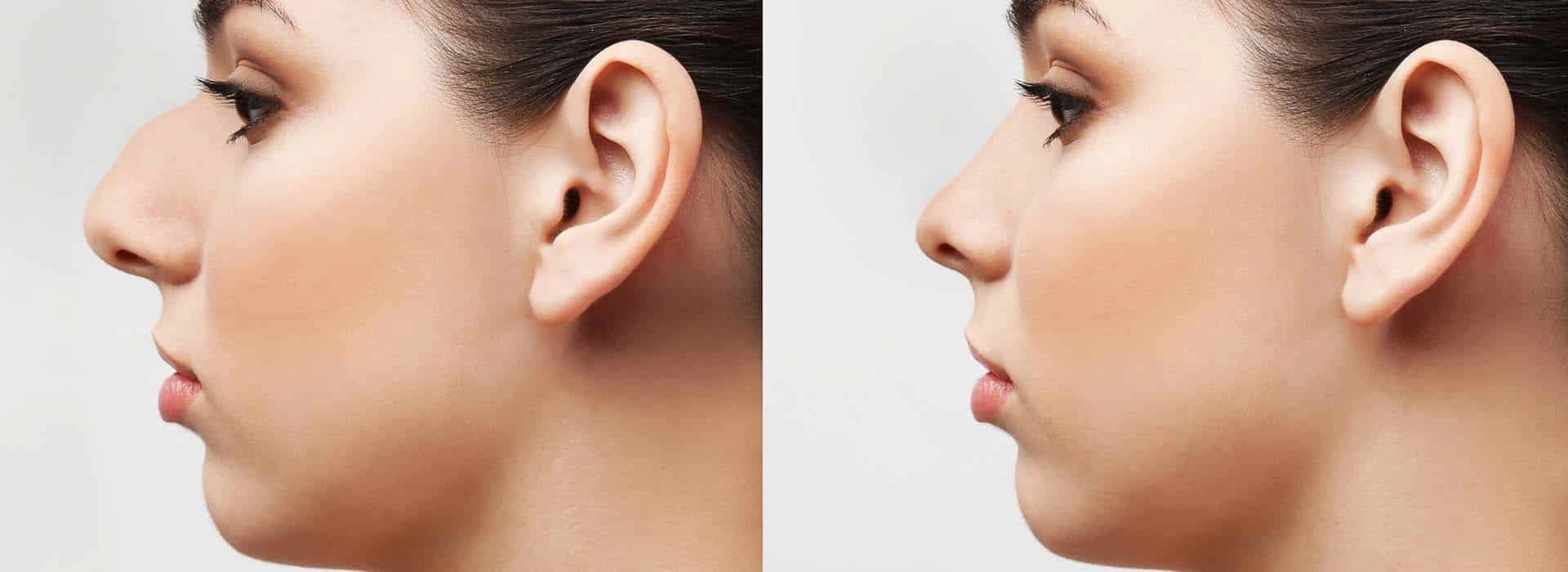 Rinoplastia de nariz ancha: Tratamiento y postoperatorio — Dr. Javier Galindo