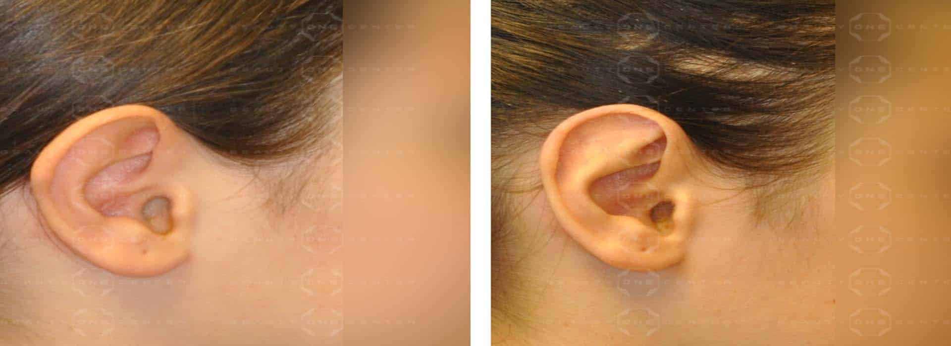 Otoplastia u operación de orejas ¿cómo es el postoperatorio? — Dr. Javier Galindo