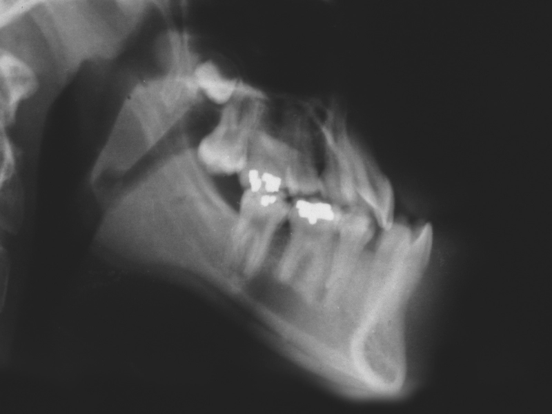 Prognatismo mandibular — Dr. Javier Galindo