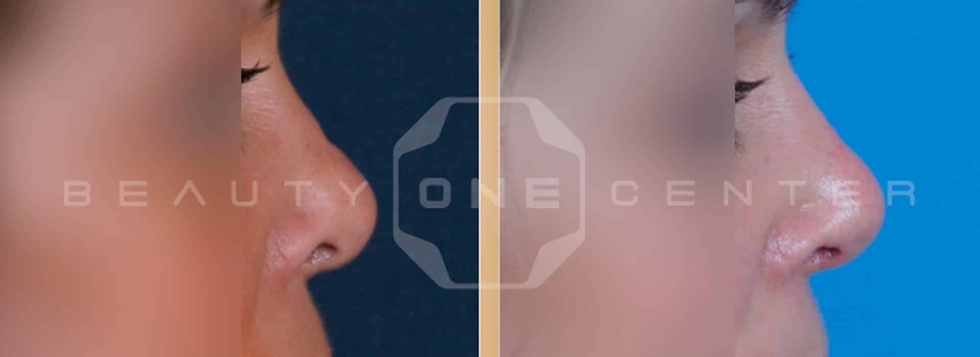 Rinoplastia con o sin cirugía ¿Qué opción es mejor? — Dr. Javier Galindo