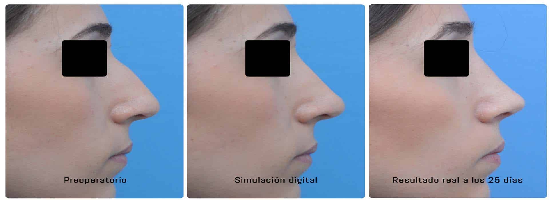 Rinoplastia: Todo lo que debes saber antes de operarte la nariz — Dr. Javier Galindo