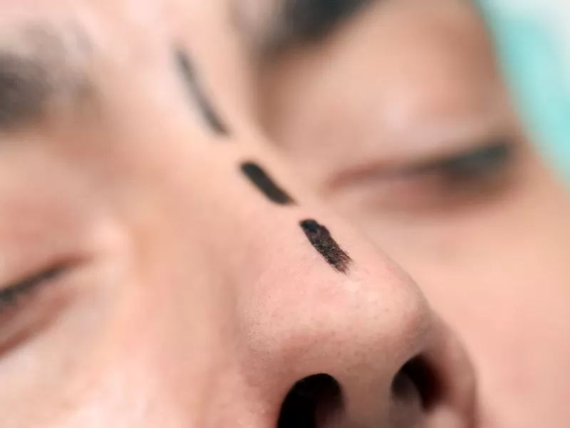 Septoplastia — Dr. Javier Galindo Madrid