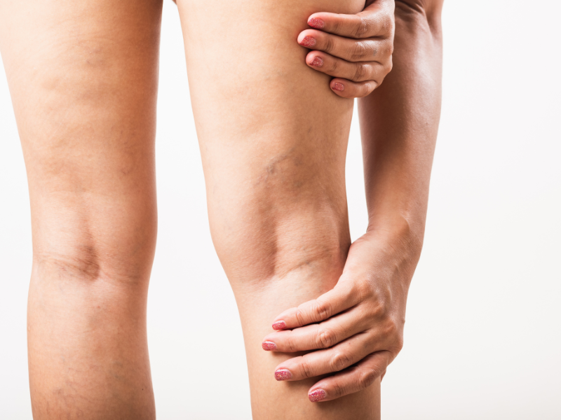 Varices — Dr. Javier Galindo