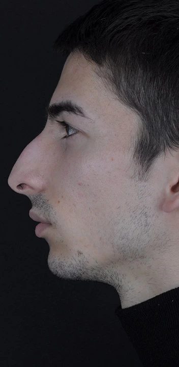 Caso 3 rinoplastia hombre — antes