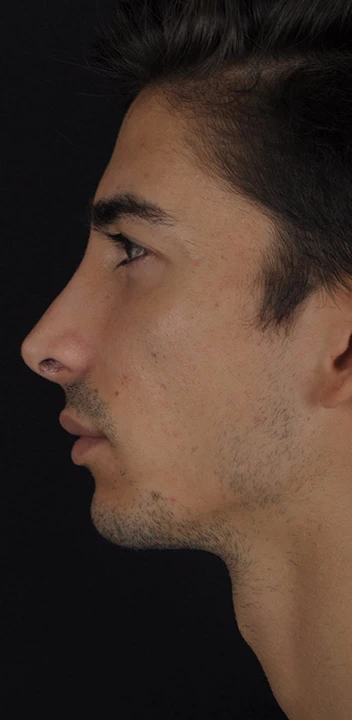 Caso 3 rinoplastia hombre — después