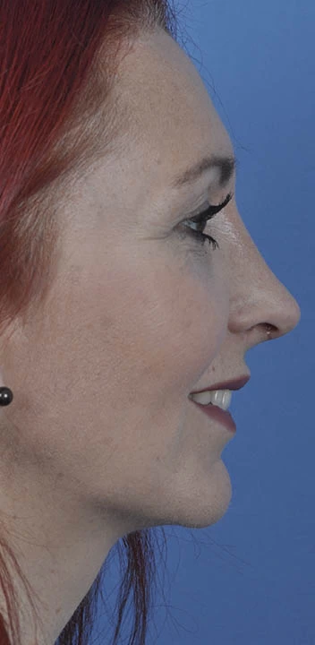 Caso 4 rinoplastia piel fina — después