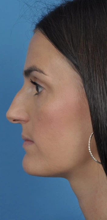 Ejemplo rinoplastia primaria — perfil antes