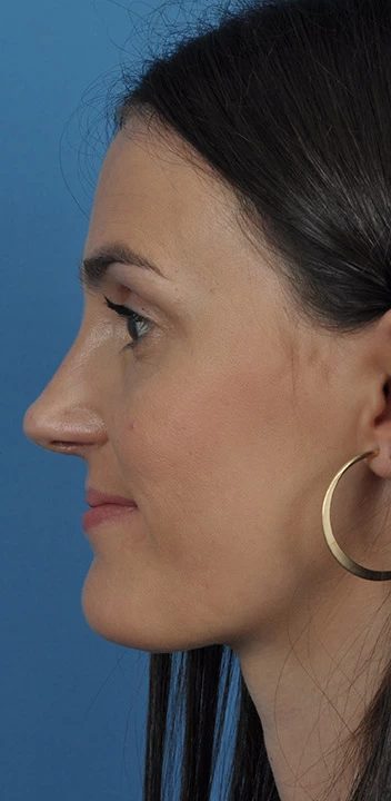 Caso 1 rinoplastia — después