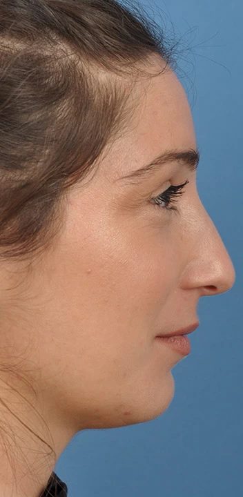 Caso 2 rinoplastia — antes