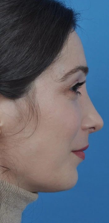 Caso 2 rinoplastia — después