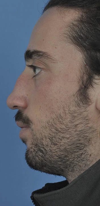 Rinoplastia secundaria — caso antes