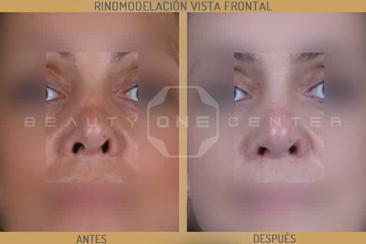 rinomodelacion frontal pre-post
