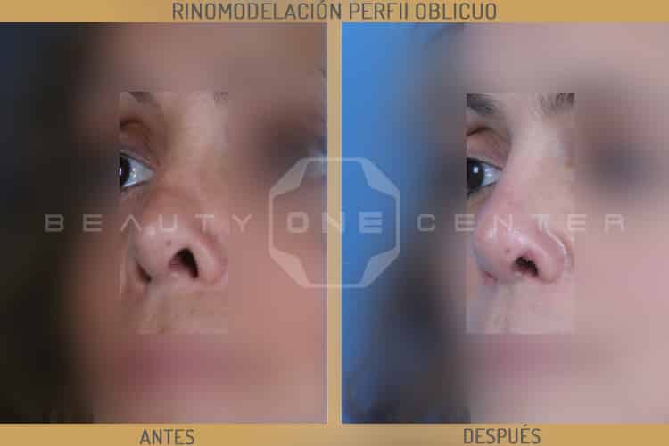 rinomodelacion perfil oblicuo pre-post