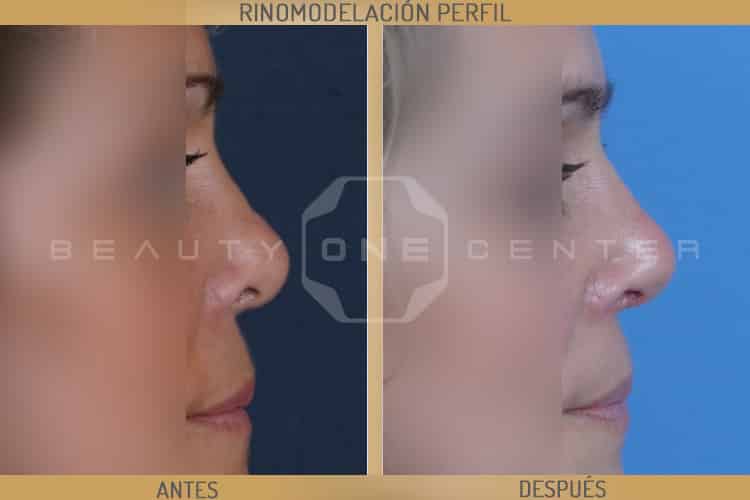 rinomodelacion perfil pre-post