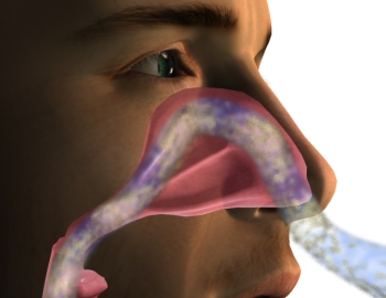 hipetrofia cornetes nasales