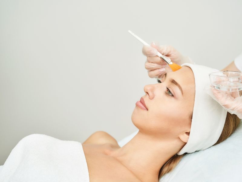 peeling químico facial