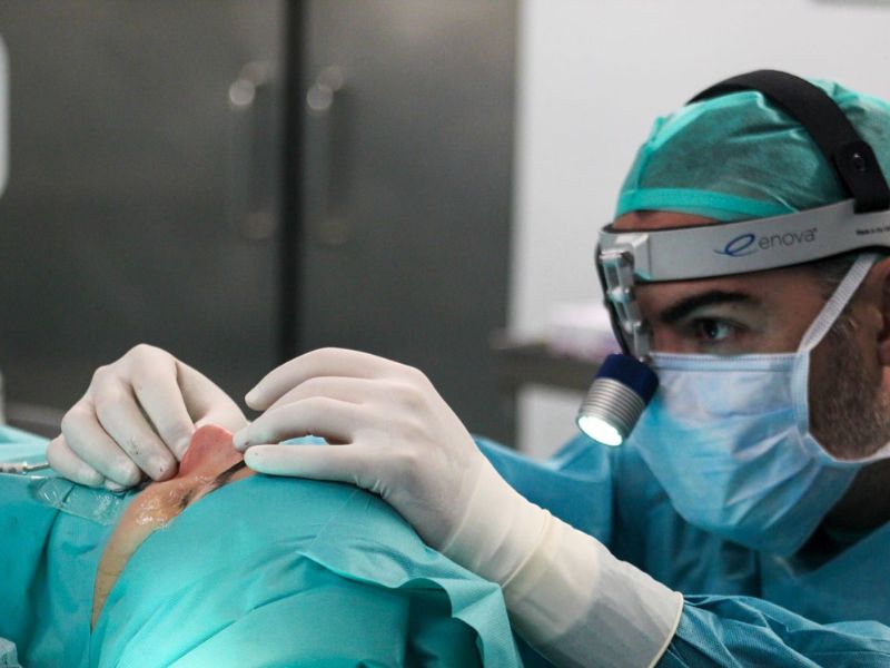 6 meses rinoplastia